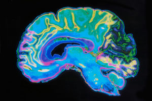 MRI scan